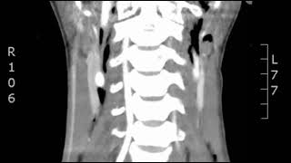 Neck Pneumomediastinum Coronal CT JETem 2018 [upl. by Ai]