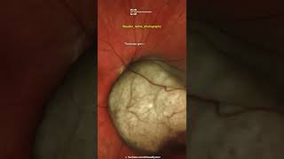 Choroidal Melanoma [upl. by Hannej122]