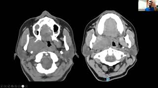 Sesión mensual de marzo  Cuello abordaje por imagen de lesiones suprahioides [upl. by Loginov]