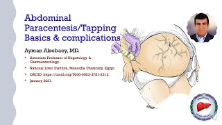 Abdominal ParacentesisT apping Basics amp complications [upl. by Ahsienal]