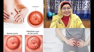 Nabothian cyst l নেবোথিয়ান সিস্ট [upl. by Vilhelmina]