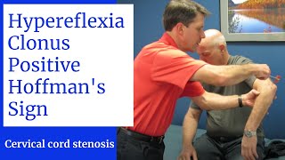 Hyperreflexia Clonus Positive Hoffmans Sign Central Cervical Spine Stenosis [upl. by Anatak539]