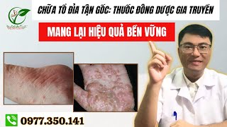 Chữa Tổ Đỉa Tận Gốc Thuốc Đông Dược Gia Truyền Mang Lại Hiệu Quả Bền Vững [upl. by Ttcos]