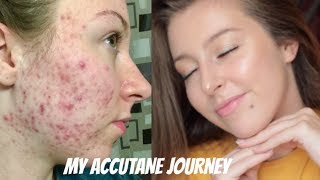 MY ISOTRETINOIN ACCUTANE JOURNEY  BEFORE AND AFTER PHOTOS [upl. by Harty923]