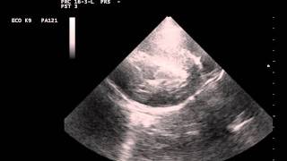 cardiomegaly and hypertrophy due to an adrenal pheochromocytomaavi [upl. by Ecyar]