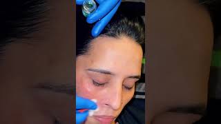 Cosmelan treatment for hyperpigmentation [upl. by Ahsenak]