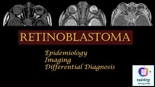 RETINOBLASTOMA Case discussion Epidemiology Imaging and Differential Diagnosis [upl. by Anaihs]