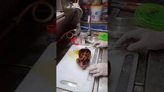 ovarian cyst cyst histopathology [upl. by Gibeon]