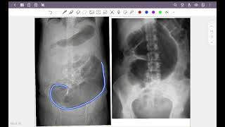 Abdominal radiograph part 3  calcification amp volvulus [upl. by Skelly]