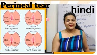 perineal trauma  perineal tear  degrees  management hindi [upl. by Trueman]