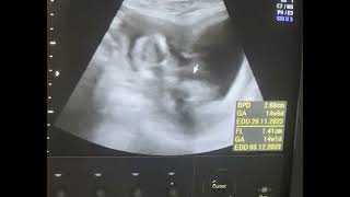 Bicornuate uterus 14wks pregnancy Diagnostic ultrasound cases [upl. by Greeson]