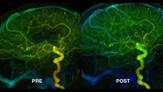 Stroke Left MCA M2 occlusion Distal aspiration  Stentriever ERIC [upl. by Krucik]