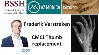 CMCJ Thumb Replacement by Dr Frederik Verstreken [upl. by Imuyam448]