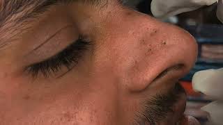 YouTube Blackheads Nose Blackheads poppingblackheads [upl. by Deloria]