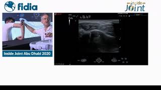 2020 US guided injections in the elbow [upl. by Onitsirc]