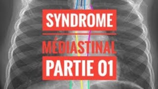 Syndrome Médiastinal  partie 01 [upl. by Aivuy]