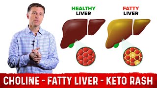 Choline One of The Best Vitamins for Fatty Liver – Dr Berg [upl. by Sandor]