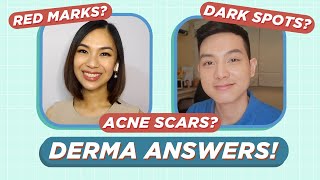 How to treat ACNE SCARS amp ACNE MARKS Dermatologist Answers Filipino  Jan Angelo [upl. by Harrington]