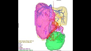 Liver Analysis by Synapse 3D [upl. by Annawal]