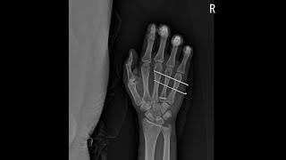 4th metacarpal base fracture [upl. by Adnofal145]