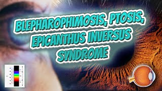 Blepharophimosis ptosis epicanthus inversus syndrome  Your EYEBALLS  EYNTK 👁️💉😳💊🔊💯✅ [upl. by Cenac]