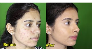 How to cover acne scars with makeup for indian skin  acne prone skin 2018 [upl. by Ynnavoeg]