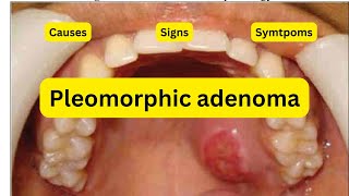 What is pleomorphic adenoma [upl. by Henriques335]