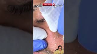 blackhead removal blackhead extraction blackhead popping [upl. by Cello853]