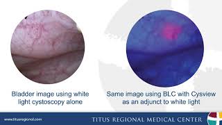 Select Few Physicians Detecting 30 More Bladder Cancer Than The Rest [upl. by Lenssen]