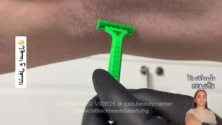 Laser hair removal laser hair removal on beard THE BEST VIDEO YOUVE SEEN TODAY [upl. by Airemaj]