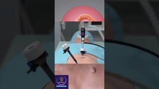 Inguinal Hernia Repair  Medical Surgery [upl. by Stralka336]