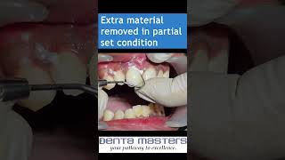 Cementation of Layered ZIRCONIA crown with GIC  step by step  shorts [upl. by Aicilat]