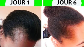 Comment Faire repousser les cheveux des tempes rapidement sans effort Faire pousser cheveux du fron [upl. by Kirsch18]