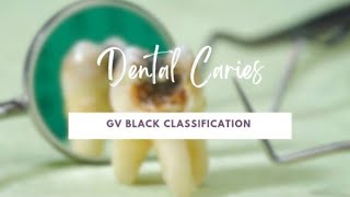 Classification of Dental Caries  GV Black classification  Dental Materials [upl. by Aimej]