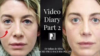 Blepharoplasty Video Diary  Day 2 After Surgery 2 of 15 [upl. by Hgielsel423]