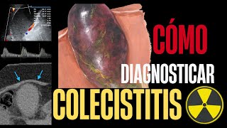 COLECISTITIS  HALLAZGOS POR IMAGEN  USGTACRMHIDA [upl. by Moll]