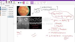 Hypotonous maculopathy [upl. by Niamrahc215]