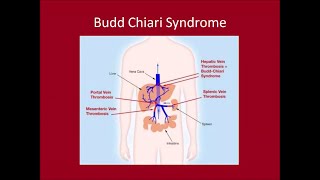 Management of Budd Chiari Syndrome [upl. by Anoved]