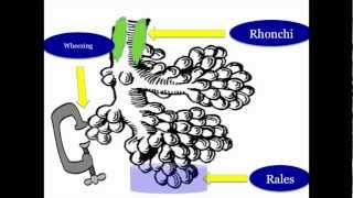 Abnormal Lung Sounds [upl. by Brandie]