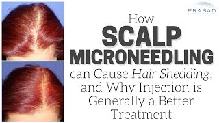 How Scalp Microneedling can Cause Temporary Hair Shedding and Advantages of Injection Treatment [upl. by Nnaitsirk]