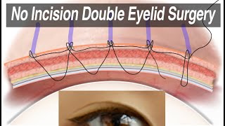 NonIncisional Asian Double Eyelid Surgery Suture Technique for Monolid Correction Animation [upl. by Itoyj]