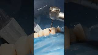 Cavity liner and composite restoration satisfying asmr [upl. by Fulcher]