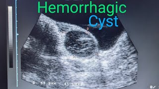 Ovary Hemorrhagic Cyst medicalimagingbyzubair ultrasound [upl. by Esyla]