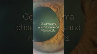 Phacodonesis and iridodonesis of ocular trauma Facodonesis e iridodonesis del trauma ocular [upl. by Ahsinyar805]