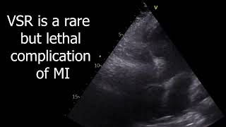 Cardiogenic shock due to VSR [upl. by Noinatrad705]