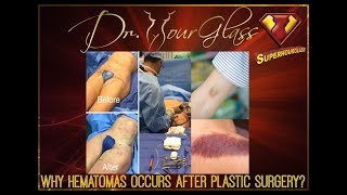 Hematomas after plastic surgery Bleeding complications [upl. by Ynahpets]