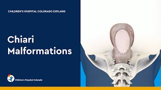 Chiari Malformation and Treatment [upl. by Eugnimod]