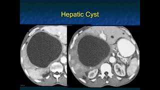 CT Evaluation of Liver Masses Key Differential Diagnosis Pathways  Part 1 [upl. by Eillib]