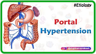 Portal hypertension USMLE Step 1  Etiology Clinical features Diagnosis and Treatment [upl. by Aikar]