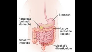 Meckels diverticulum [upl. by Trueblood591]